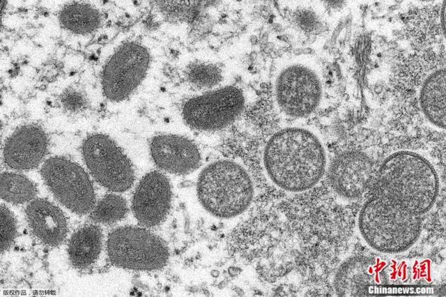 致死率可达10%！多国报告猴痘病例 专家忧或现社区传播5159 作者:橘子彤彤 帖子ID:82479 致死,致死率,可达,多国,报告